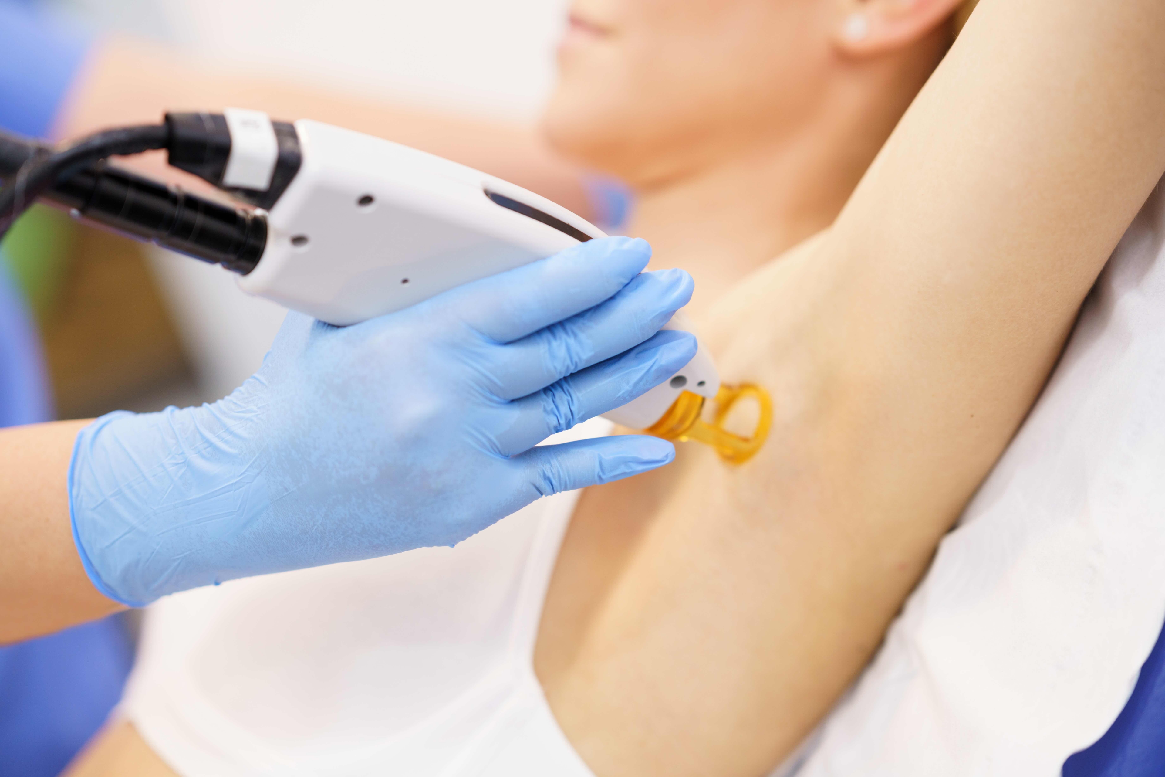 Laser Hair Removal in Chandler, AZ